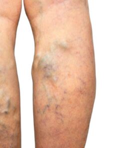 Varicose  Veins -  1 oz